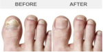 Laser Nail Fungus Removal Before and After Laser Treatment
